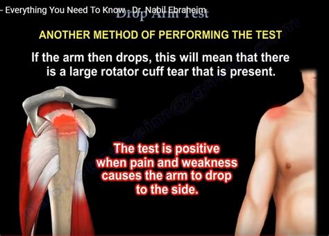 drop test shoulder exam|drop arm test positive means.